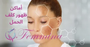 أماكن ظهور كلف الحمل